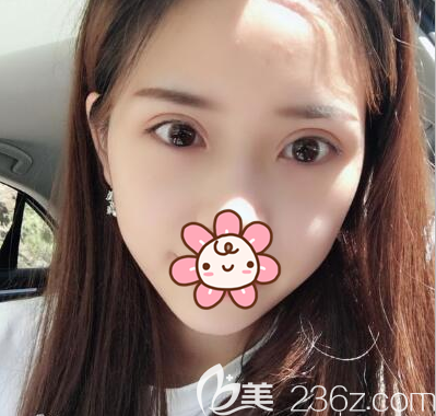 李烈帕克法双眼皮术后2个月恢复照 李烈帕克法双眼皮术后2个月恢复照