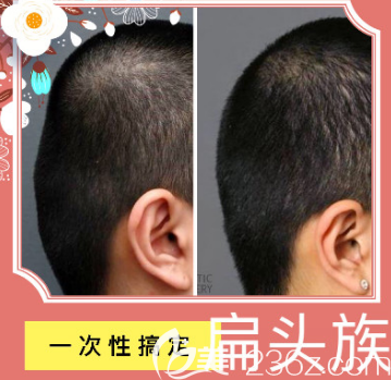 韩国爱婷男士后脑勺骨水泥填充案例效果对比图