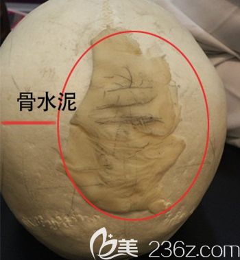 韩国ITEM爱婷填充后脑勺使用材料