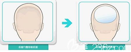 韩国ITEM爱婷填充后脑勺手术
