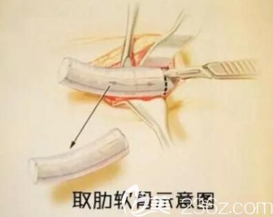 取自体肋软骨示意图 取自体肋软骨示意图