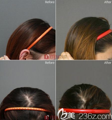 韩国爱婷后脑勺填充手术案例