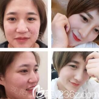 沈阳名流肋软骨隆鼻真人前后效果对比 沈阳名流肋软骨隆鼻真人前后效果对比