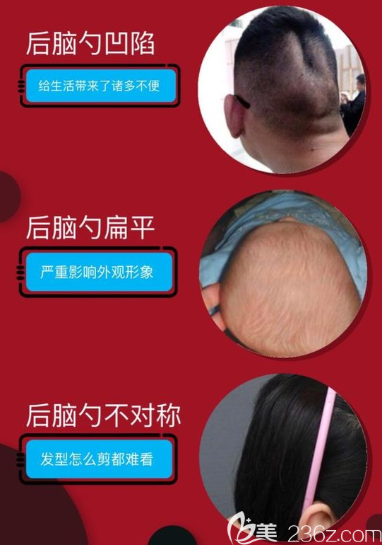 哪些人适合做后脑勺填充？后脑勺凹陷、扁平、不对称者