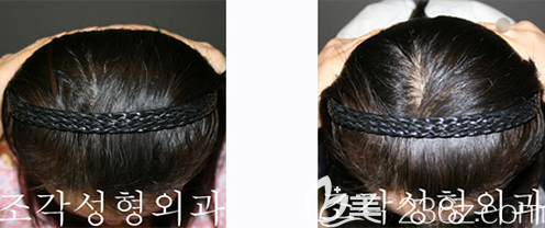 韩国雕刻宋龙泰后脑勺填充案例前后效果对比图