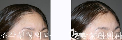 韩国雕刻宋龙泰骨水泥填充头案例