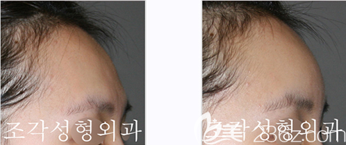额头不饱满的侧面照与骨水泥填充整形后效果对比