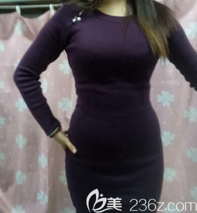 我在美丽焦点整形做腰腹部吸脂减肥术后第10天 我在美丽焦点整形做腰腹部吸脂减肥术后第10天