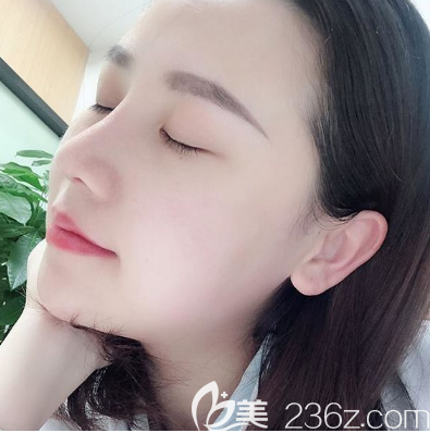 佛山曙光金子宋仁刚博士做的隆鼻子案例