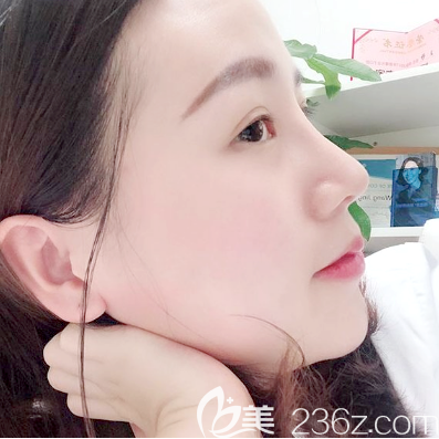 佛山曙光金子宋仁刚隆鼻案例20天自拍