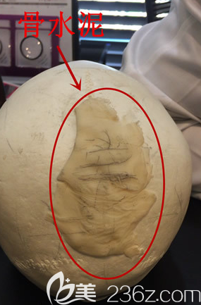 骨水泥填充后脑勺模拟图片