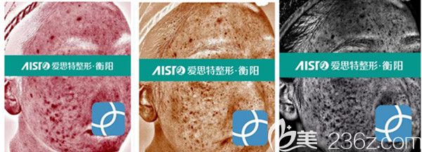 氐殊治疗前VISIA仪器检测分析