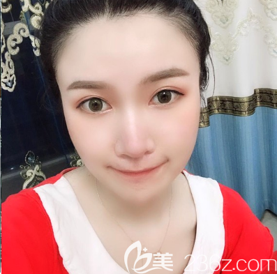 佛山曙光金子李淑薇双眼皮案例一个月自拍 佛山曙光金子李淑薇双眼皮案例一个月自拍