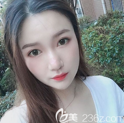 全切双眼皮术后7天拆线效果图 全切双眼皮术后7天拆线效果图