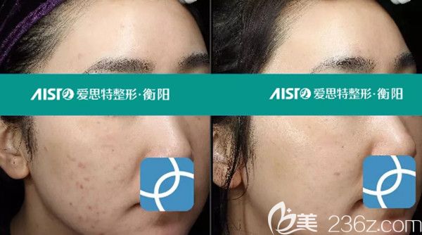 氐殊治疗前后效果图