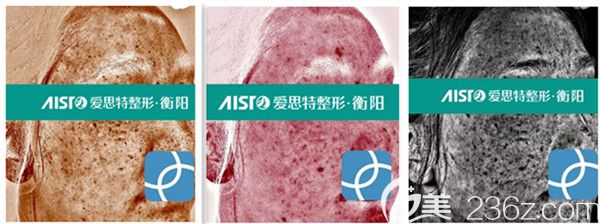 氐殊治疗后VISIA仪器检测分析