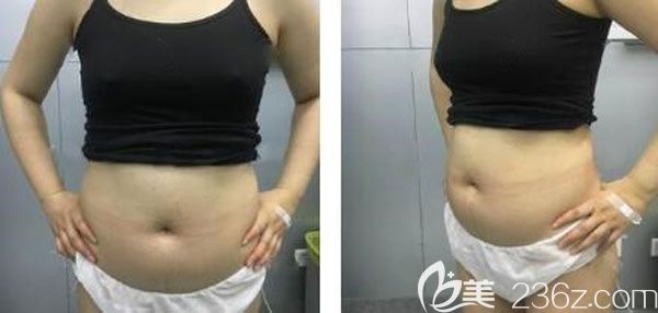 在昆明韩辰整形吸脂手术前 在昆明韩辰整形吸脂手术前