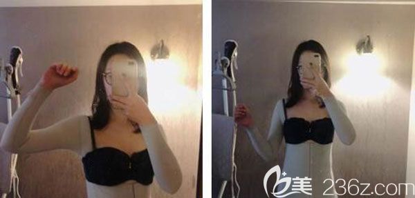 腰腹吸脂术后第7天肿胀基本已经消退 腰腹吸脂术后第7天肿胀基本已经消退