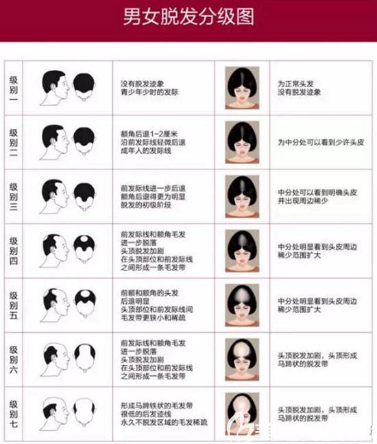 韩国毛杰琳分析男女脱发的等级