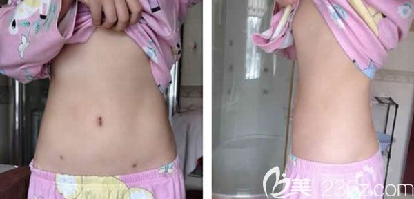 腰腹部塑形第10天淤青已经基本消退 腰腹部塑形第10天淤青已经基本消退