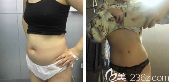 在昆明韩辰整形找胡乔做腰腹部吸脂手术前后效果对比图 在昆明韩辰整形找胡乔做腰腹部吸脂手术前后效果对比图