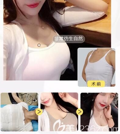 到常州美贝尔做隆胸前后对比案例
