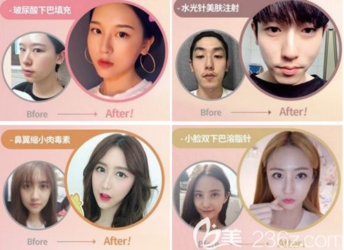 韩国缪慈微整形案例展示 韩国缪慈微整形案例展示