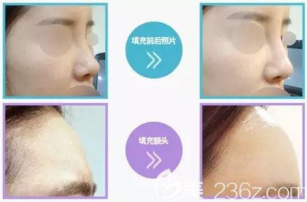 韩国清潭珠颜玻尿酸注射案例 韩国清潭珠颜玻尿酸注射案例