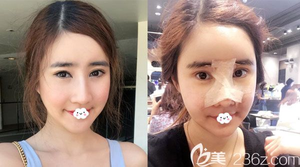 在韩国ID整形做双鄂手术3个月后又来做假体隆鼻