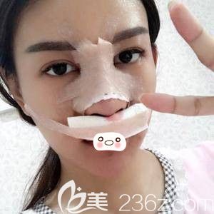 洛阳王静医疗美容诊所做鼻综合手术三天