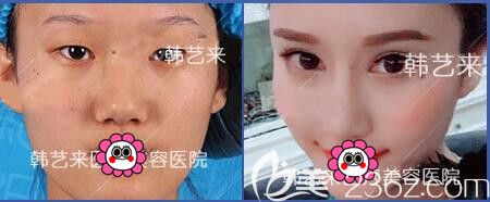 佳木斯韩艺来双眼皮案例