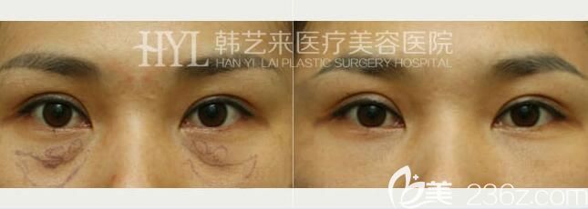 佳木斯韩艺来祛眼袋效果
