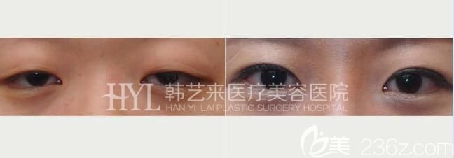 佳木斯韩艺来上眼睑下垂效果对比