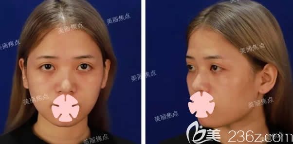 我在桂林美丽焦点整形做自体脂肪填充前照片 我在桂林美丽焦点整形做自体脂肪填充前照片