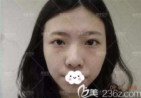 双眼皮面部填充术前照片 双眼皮面部填充术前照片