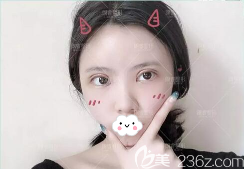 双眼皮面部填充术后5天 双眼皮面部填充术后5天