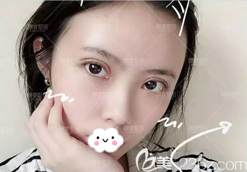 切开双眼皮+脂肪面填10天恢复效果 切开双眼皮+脂肪面填10天恢复效果