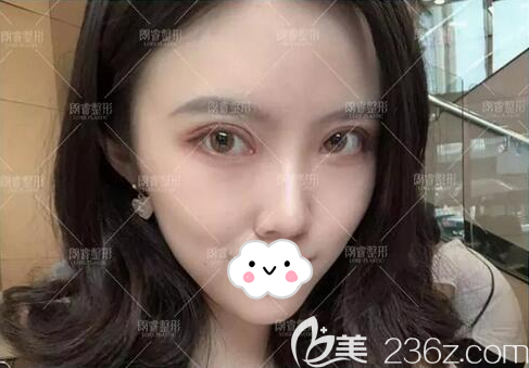 脂肪胶填充面部术后20天恢复效果 脂肪胶填充面部术后20天恢复效果