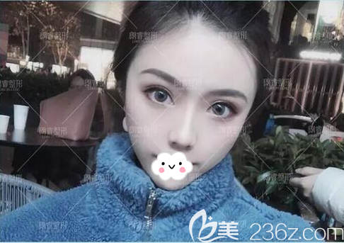 半年前我在做了双眼皮和SVF脂肪胶填充面部，我觉得应该分享下自己的恢复图片