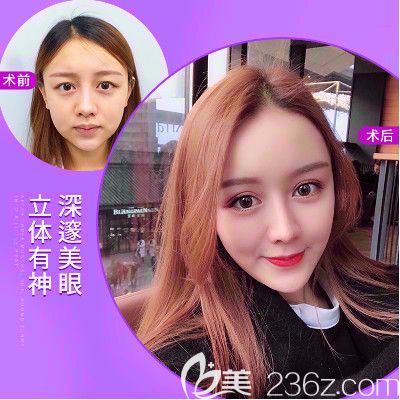 普宁安琪整形医院双眼皮案例 普宁安琪整形医院双眼皮案例