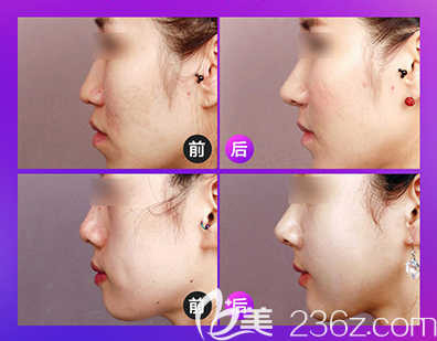 普宁安琪医院医疗美容科隆鼻案例 普宁安琪医院医疗美容科隆鼻案例