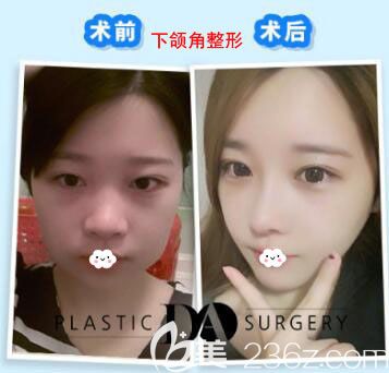 韩国DA医院院长去下颌角案例效果对比力图