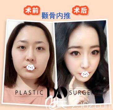 这是韩国DA整形医院颧骨内推案例