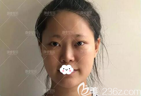 照房志强做鼻修复的术前照 照房志强做鼻修复的术前照