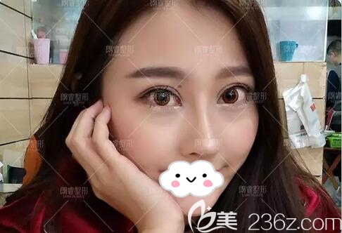 隆鼻+面部脂肪填充术后20天 隆鼻+面部脂肪填充术后20天