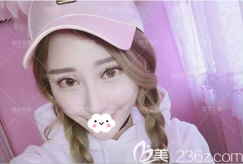 房志强半肋软骨隆鼻修复术后一个月 房志强半肋软骨隆鼻修复术后一个月