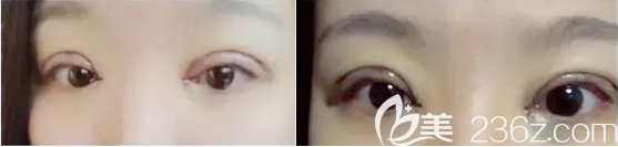 杨林双眼皮开眼角术后即刻