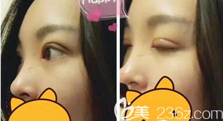 切开双眼皮术后10天恢复效果