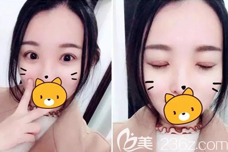 杨林切开双眼皮微创开眼角45天