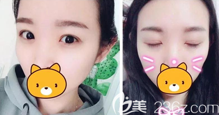 广元美华整形美容医院双眼皮开眼角3个月恢复照